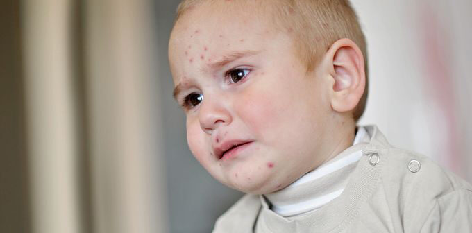 Neurodermitis bei Babys und Kindern: die richtige Hautpflege