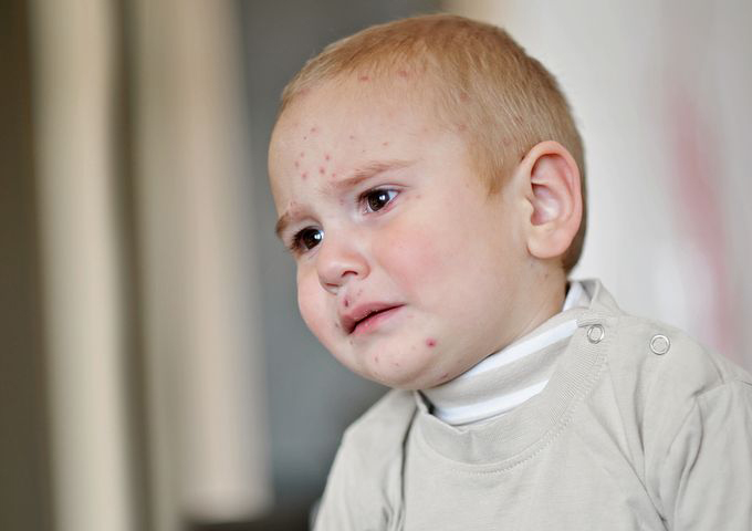 Neurodermitis bei Babys und Kindern: die richtige Hautpflege