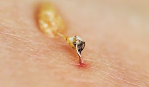 Insektenstiche behandeln: Der Urheber für die Schmerzen und die Schwellung ist das Insektengift, das mit dem Stachel in die Haut eindringt. (#03)